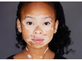 Боротьба з собою: аутоімунні захворювання й їх діагностика Боротьба з собою: аутоімунні захворювання й їх діагностика